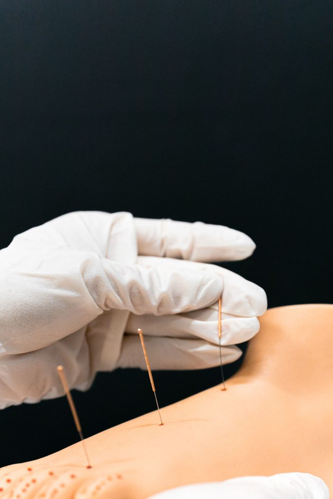 Acupuncture et acupression : quelles différences ?