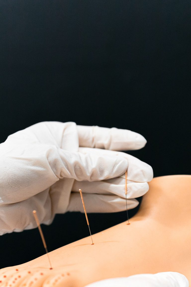 Acupuncture et acupression : quelles différences ?